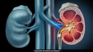 शरीर के इन 4 हिस्सों का दर्द हो सकता है किडनी डिजीज का संकेत, वक्त पर सावधान होना है जरूरी